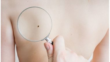 Melanoma: 5 Things You Need to Know About Malignant Skin Cancer