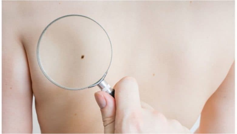 Melanoma: 5 Things You Need to Know About Malignant Skin Cancer Melanoma: 5 Things You Need to Know About Malignant Skin Cancer