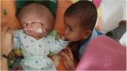 Two-Month-Old Baby Born with Two Faces in Indonesia! Conjoined Twin Failed to Develop a Body (View Pic)