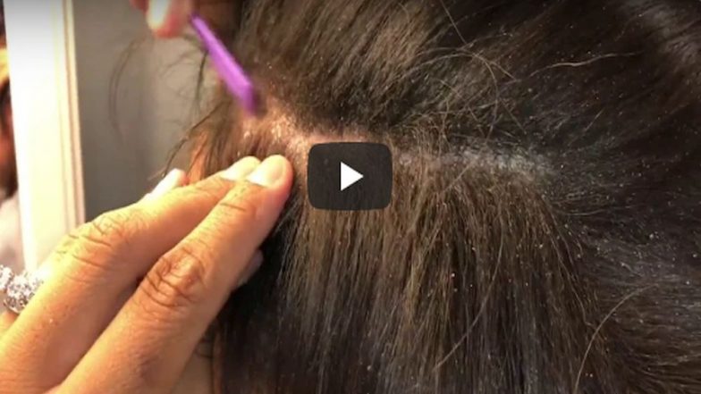 Dandruff-Scraping Videos Have Taken Over Pimple-Popping As The Most Grossly Satisfying Videos On The Internet