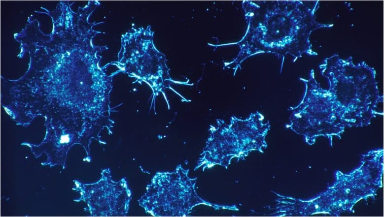 Inflammatory Bowel Disease Ups Prostate Cancer Risk: Study Inflammatory Bowel Disease Ups Prostate Cancer Risk: Study