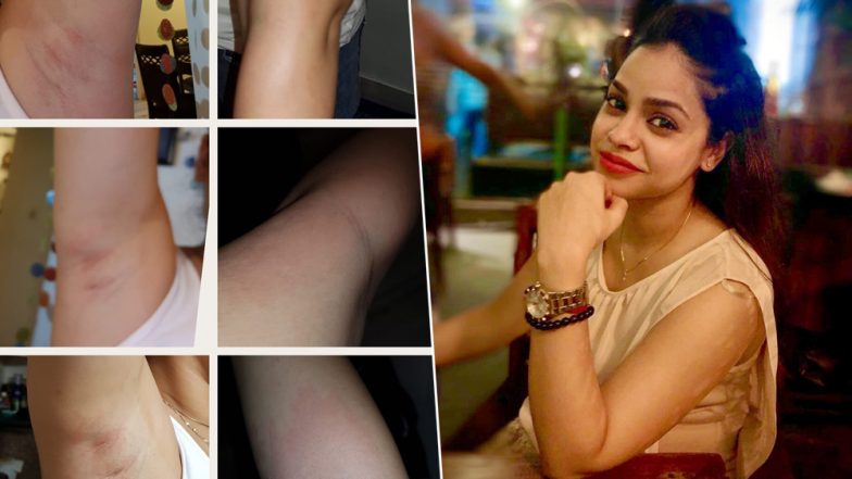 Sumona Chakravarti Slams UrbanClap's Shoddy Beauty Services That Left Her Skin Blotched And Bruised - view pic