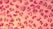 Gonorrhoea Symptoms Are More Prominent in Men Than In Women, Says Study