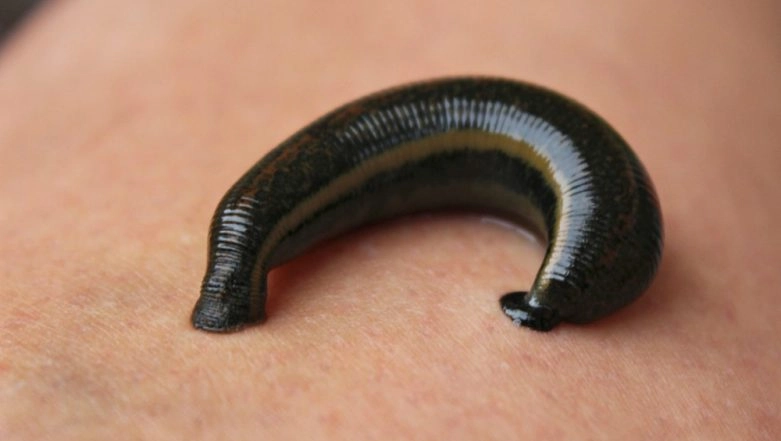Leech Enters Cambodian Man's Penis Sucking About A Pint of Blood