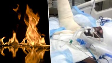 'Fire Challenge' on Internet Leaves 12-Year-Old Girl With Severe Burns! Not Just Kiki & Momo Challenge is Dangerous