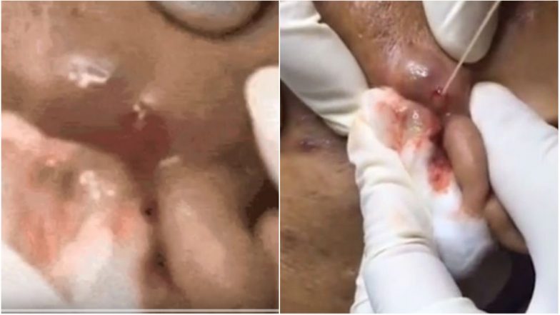 Huge Pimple Popped on Vietnam Man’s Head! Watch the Visually-Disturbing Video