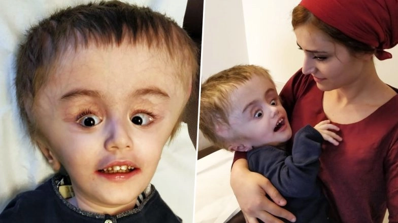 Two Year Old Kid Suffering From Gross Congenital Hydrocephalus with Megalencephaly Successfully Treated at Fortis Gurgaon