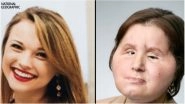 21-Year-Old Girl Becomes Youngest to Receive Face Transplant in the US, After She Shot Herself in An Attempted Suicide (Watch Video)