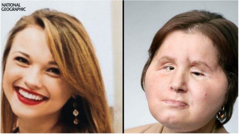 21-year-old receives historic face transplant