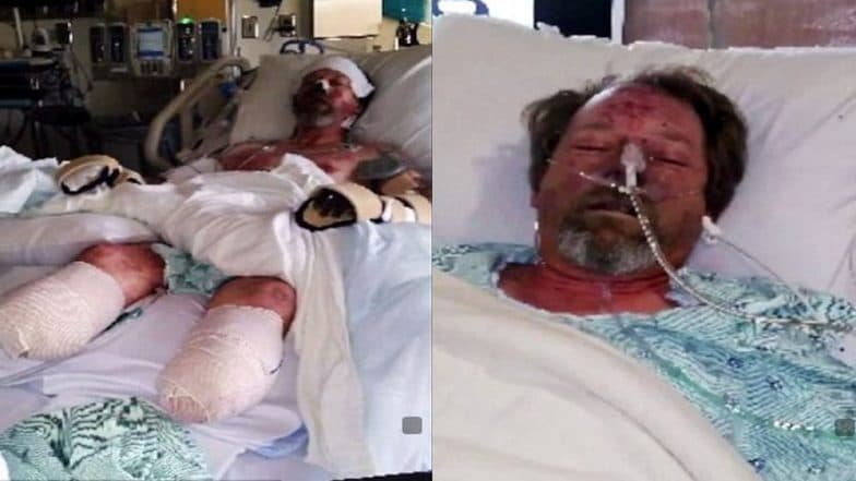 Pet Lovers Beware! US Man’s Hands and Legs Were Amputated After Pet Dog Licks Them