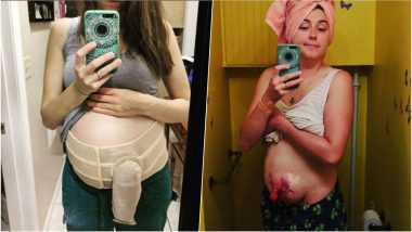 Pregnant with Flesh-Eating Infection! Mother of Two Shares Her Real-Life Story