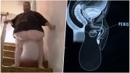 Man With 35 Kg Testicles Undergoes Life-Saving Surgery, Finally Gets To Have Sex With Wife After 7 Years