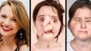 Face Transplant: How Surgeons Graft A Dead Donor's Face On a Living Recipient In This Complicated Surgery