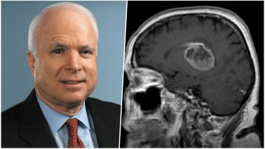 John McCain Died of Glioblastoma, The Deadliest and The Most Untreatable Form of Brain Cancer