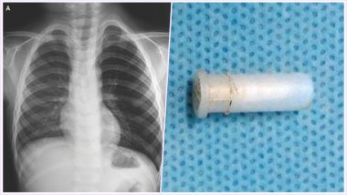 Boy’s Whistling Cough! Not a Disease, but a Toy Whistle Lodged in His Throat: Watch Video