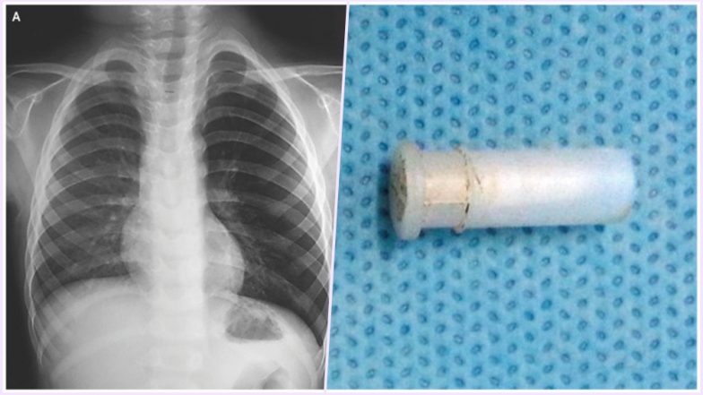 Boy’s Whistling Cough! Not a Disease, but a Toy Whistle Lodged in His Throat: Watch Video