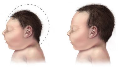 NBRC Researchers Find Out How Zika Virus Causes Microcephaly or Smaller Head Size in Infants