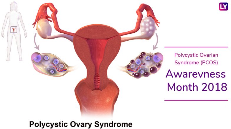 Polycystic Ovarian Syndrome (PCOS) Awareness Month 2018: Symptoms of the Endocrine Disorder That Usually Go Unnoticed