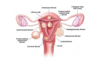 Uterine Fibroid and Its Types: 28 Kg Giant Fibroid Removed from a Woman in Singapore
