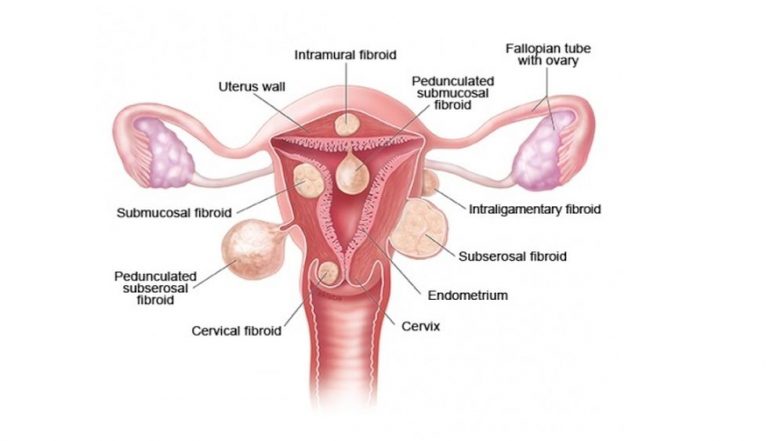Uterine Fibroid and Its Types: 28 Kg Giant Fibroid Removed from a Woman in Singapore
