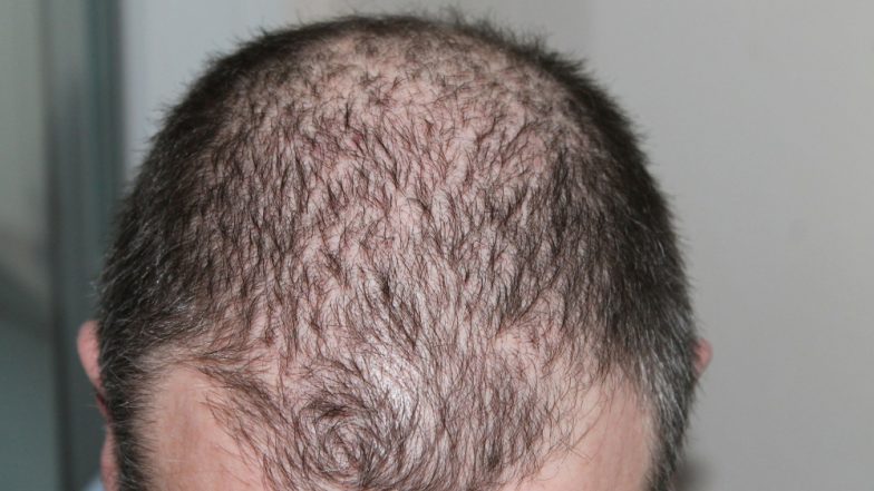 Cure For Baldness? Wearable LED Device Could Help Regrow Hair