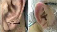Do You Have A Crease On Your Earlobe? Indian Doctor Says It&rsquo;s A Sign of Heart Disease