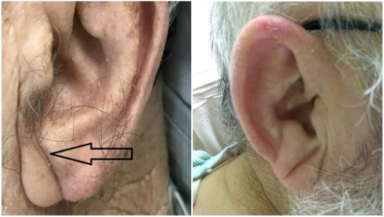 do-you-have-a-crease-on-your-earlobe-indian-doctor-says-it-s-a-sign-of-heart-disease-latestly