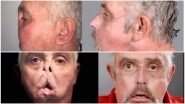 Face Transplant Successfully Carried Out On 64-Year-Old Who Became The World&rsquo;s Oldest Recipient