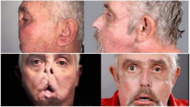 Face Transplant Successfully Carried Out On 64-Year-Old Who Became The World’s Oldest Recipient