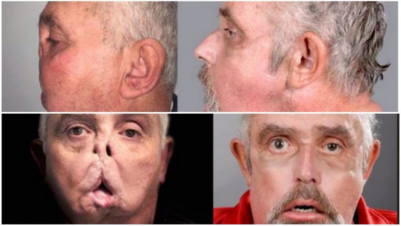 Face Transplant Successfully Carried Out On 64-Year-Old Who Became The World&rsquo;s Oldest Recipient