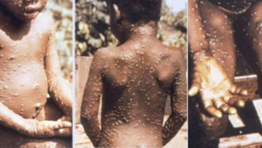 Monkeypox and Its Symptoms: UK Sees Its First Confirmed Case of the Rare Viral Infection