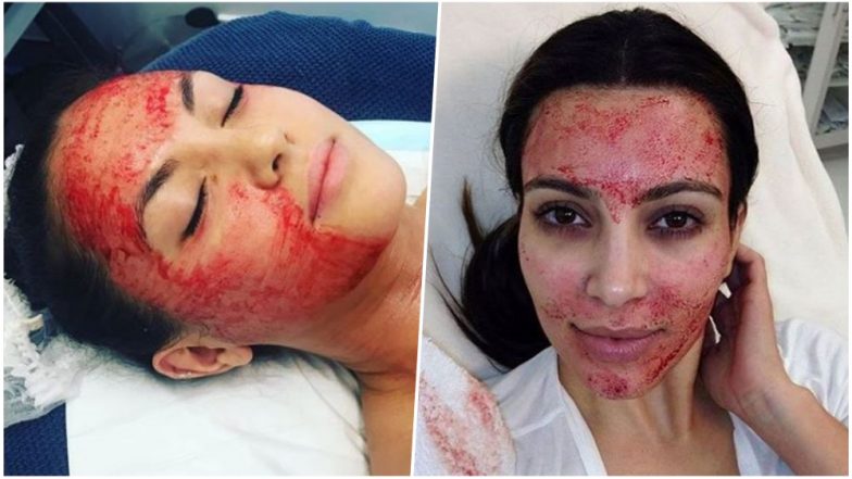 Vampire Facial Suspected of Carrying HIV Risk! Here’s What You Need To Know About This Controversial Beauty Treatment
