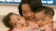 Conjoined Bhutanese Twins Girls Nima and Dawa to Undergo Separation Surgery in Australia
