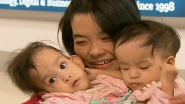Conjoined Bhutanese Twins Girls Nima and Dawa to Undergo Separation Surgery in Australia