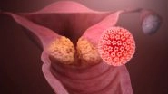 Human Papillomavirus (HPV): Causes, Symptoms and Treatment of the Most Common Sexually Transmitted Infection That Can Lead to Cancer