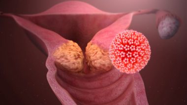 Human Papillomavirus (HPV): Causes, Symptoms and Treatment of the Most Common Sexually Transmitted Infection That Can Lead to Cancer