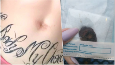 Woman Regrets Removing Her Belly-Button To Gift it to Her Boyfriend, Calls Her Decision 'Impulsive'