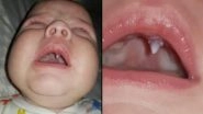 SHOCKING! Fang Grows Inside Baby&rsquo;s Mouth Overnight, Leaving Doctors Confused (See Pics)