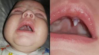 SHOCKING! Fang Grows Inside Baby’s Mouth Overnight, Leaving Doctors Confused (See Pics)