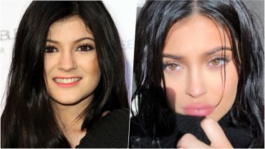 Lip Fillers: 6 Things You Should Know About Before and After Tricks of Lip Augmentation