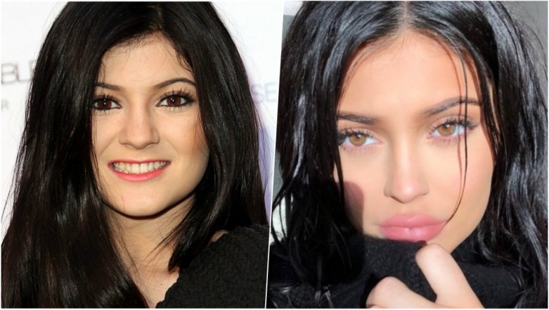 lip-fillers-6-things-you-should-know-about-before-and-after-tricks-of