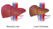 Liver Transplant: Real Medical Stories That Show Not All Liver Failures Require a Transplant