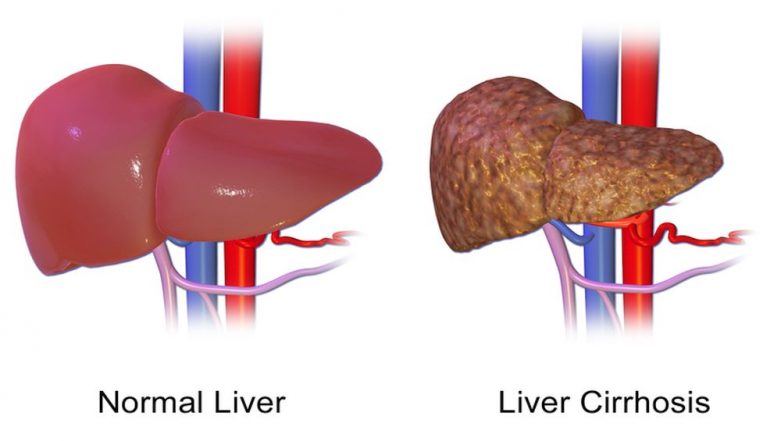 Liver Transplant: Real Medical Stories That Show Not All Liver Failures ...