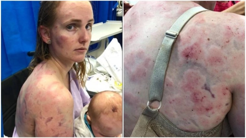 Australian Mother Badly Injured by Hailstorm Trying to Save Daughter