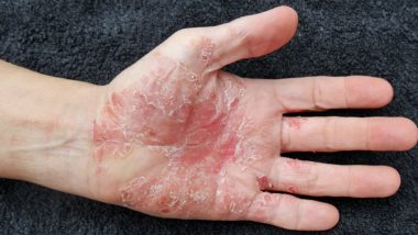World Psoriasis Day 2018: Causes, Symptoms and Treatment of This Chronic Inflammatory Skin Disease