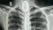 Chinese Man Swallowed Spoon a Year Ago! Doctors Finally Retrieve It From His Food Pipe; View Pics