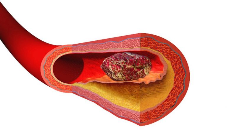 World Thrombosis Day 2018: Objective and Significance of the Day, and Risk Factors of The Clot-Forming Condition