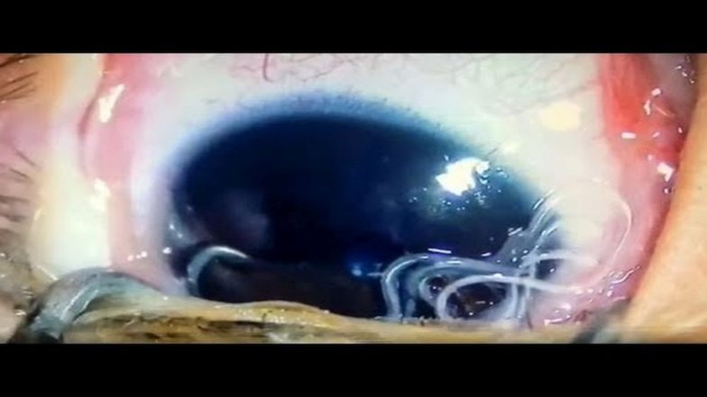 11 Wriggling Worms Pulled Out of Baby’s Eyeball After the Infant Catches Infection From Neighbour’s Dog