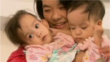 Bhutanese Conjoined Twins to Be Separated by Australian Surgeons in a 6-Hour Long Operation (View Pic)