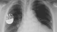 Bad Quality Pacemakers, Hip Implants Responsible For 83,000 Deaths? Poorly-Tested Medical Equipment May Be Unsafe, Says Study
